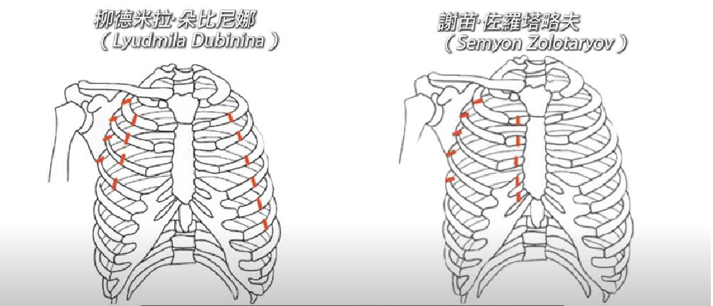 多比尼娜和佐洛塔列夫的肋骨全部折断