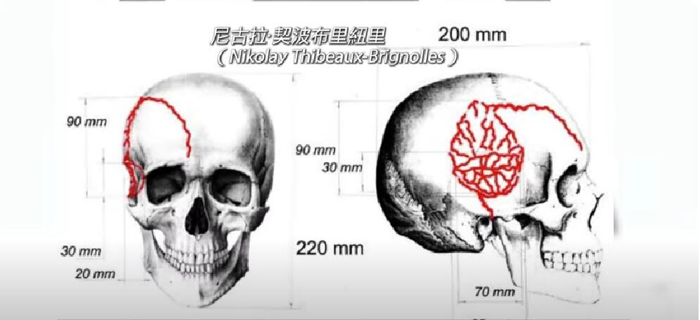 奇波布鲁努利的头骨被彻底粉碎